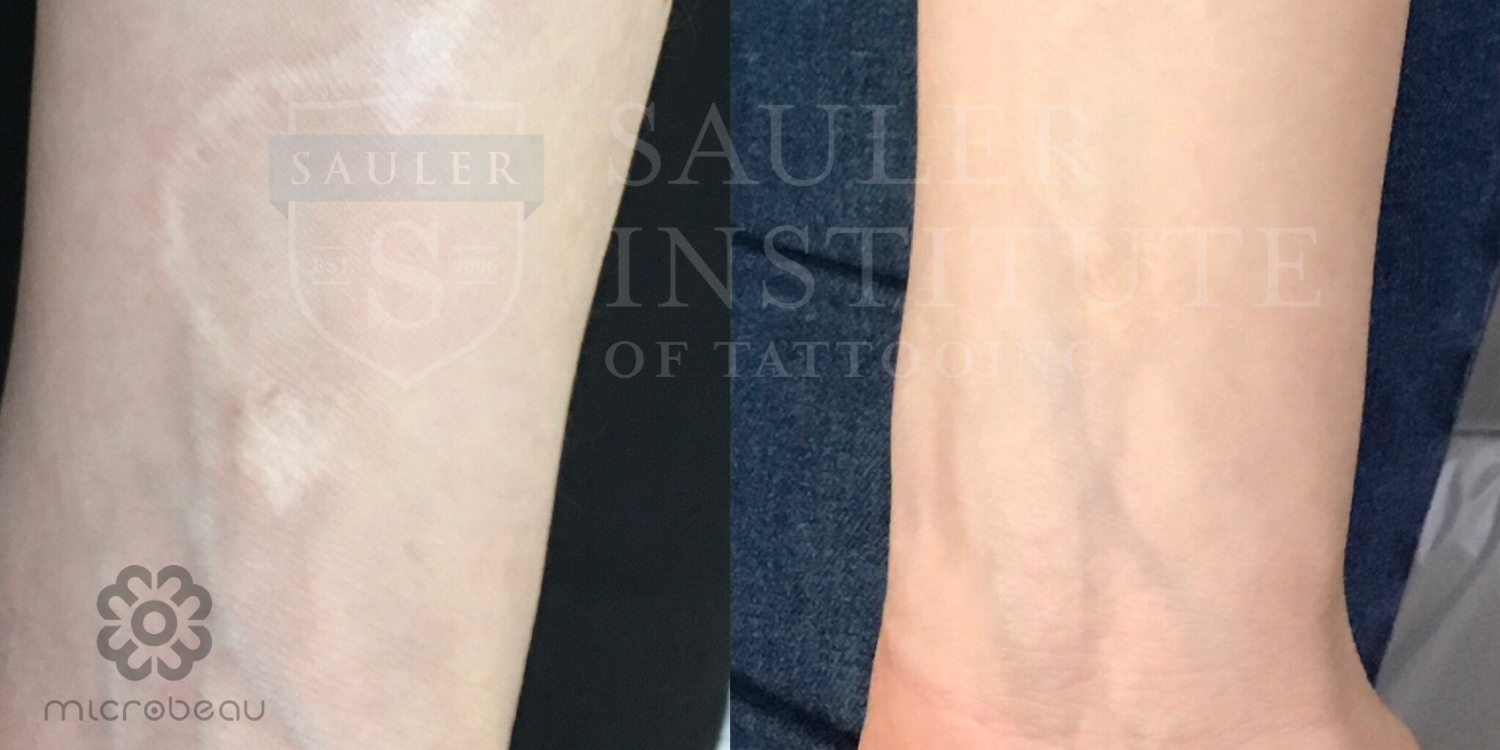 What is Scar Camouflage Tattooing? A Complete Guide
