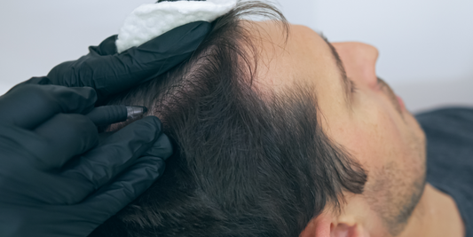 A man receiving a scalp micropigmentation treatment to restore his receding hairline and crown density.