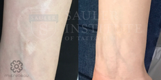 What is Scar Camouflage Tattooing? A Complete Guide