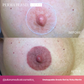 LUXE Unstoppable Areola Set by Vicky Martin Areola - Microbeau International LUXE Unstoppable Areola Set by Vicky Martin Areola